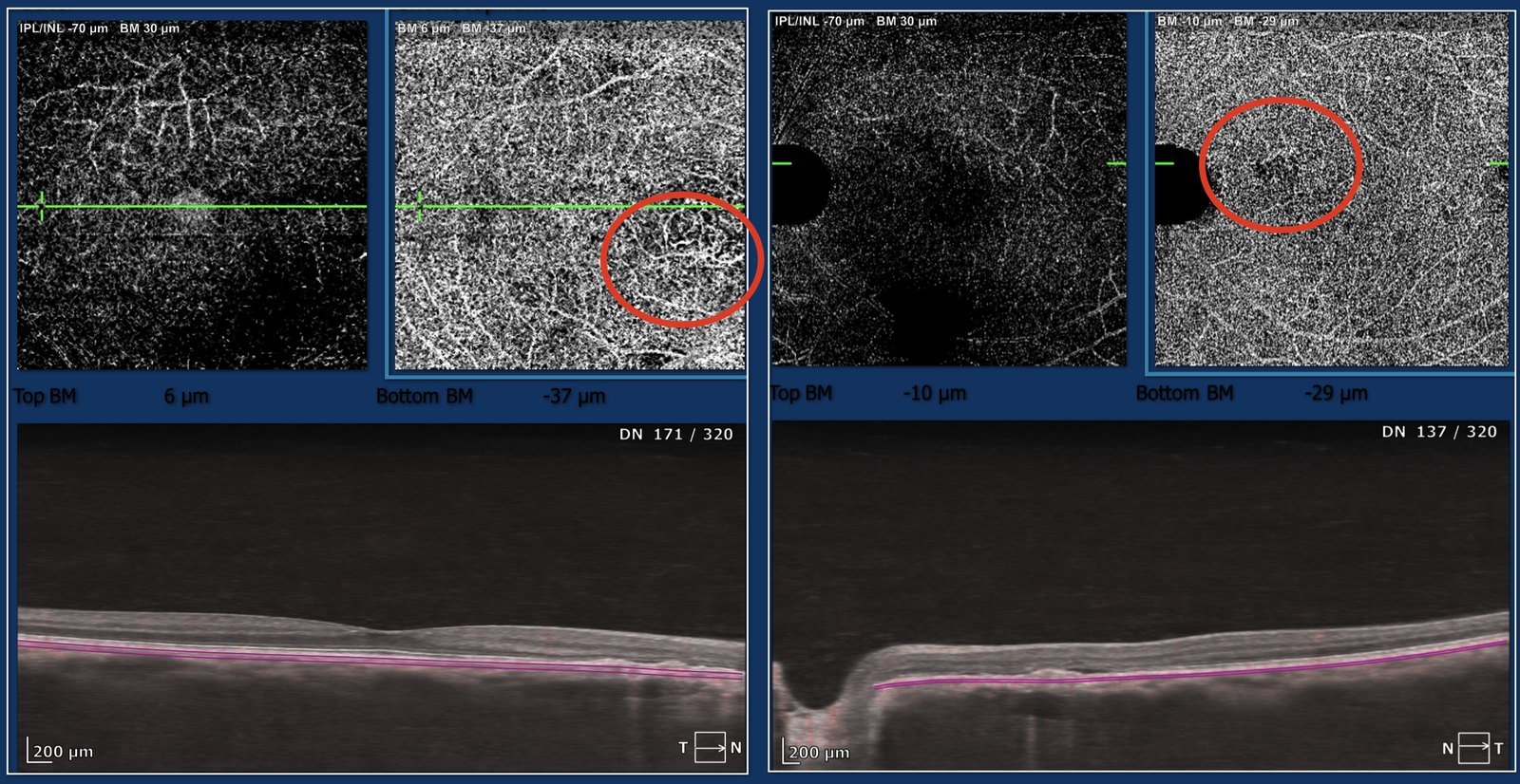 OCT-angiography of both eyes