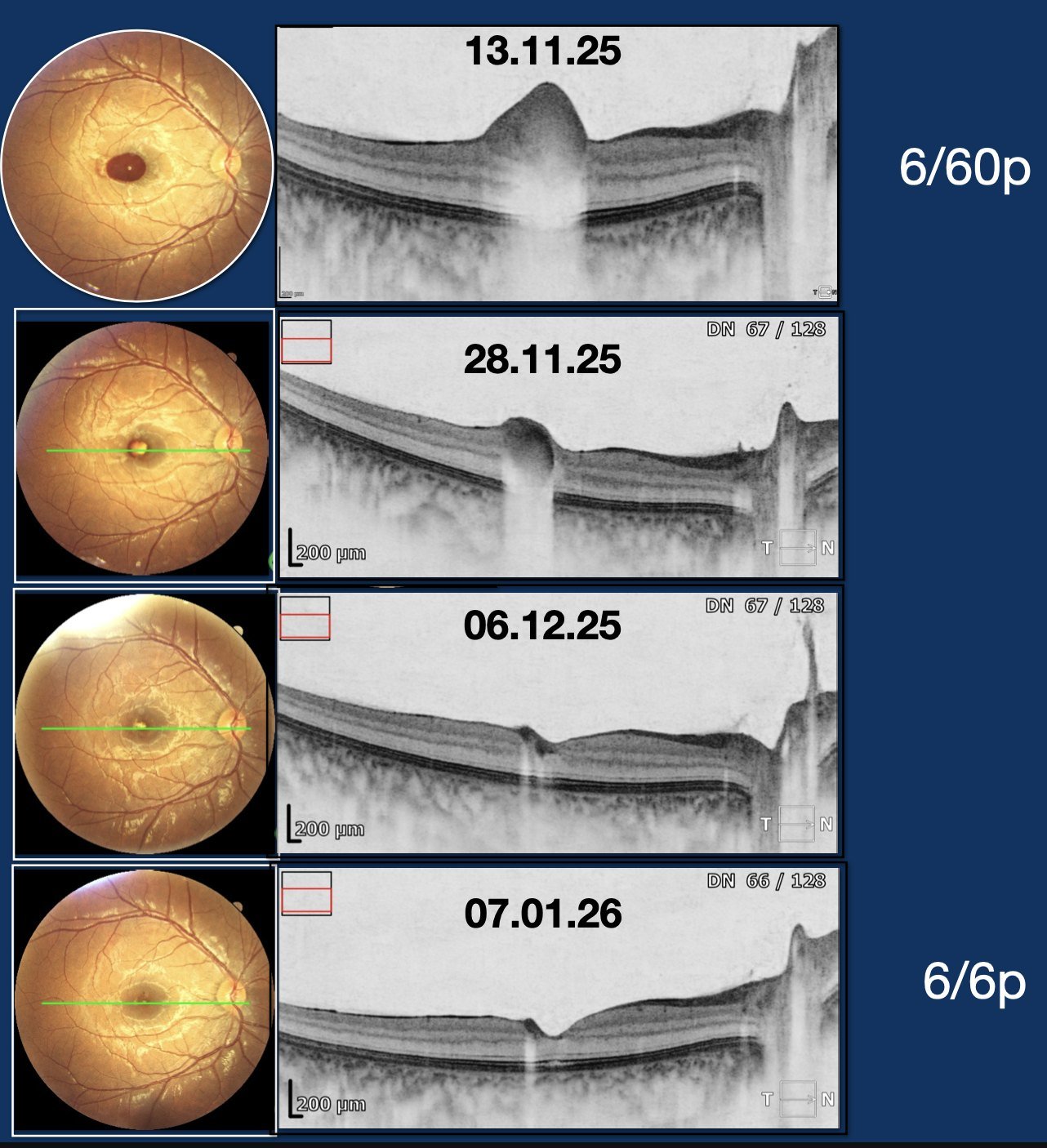 Serial follow-up showing clearing of the haemorrhage
