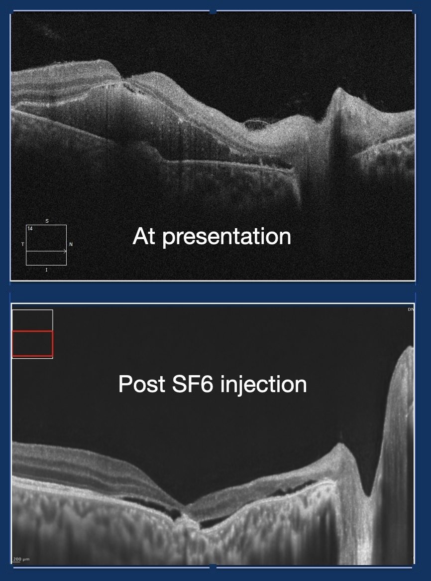 Cricket-ball injury before and after intravitreal SF6 gas