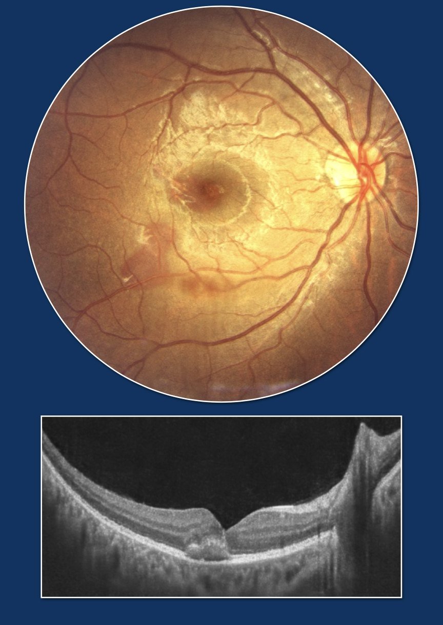 Firecracker injury with small submacular haemorrhage, observed