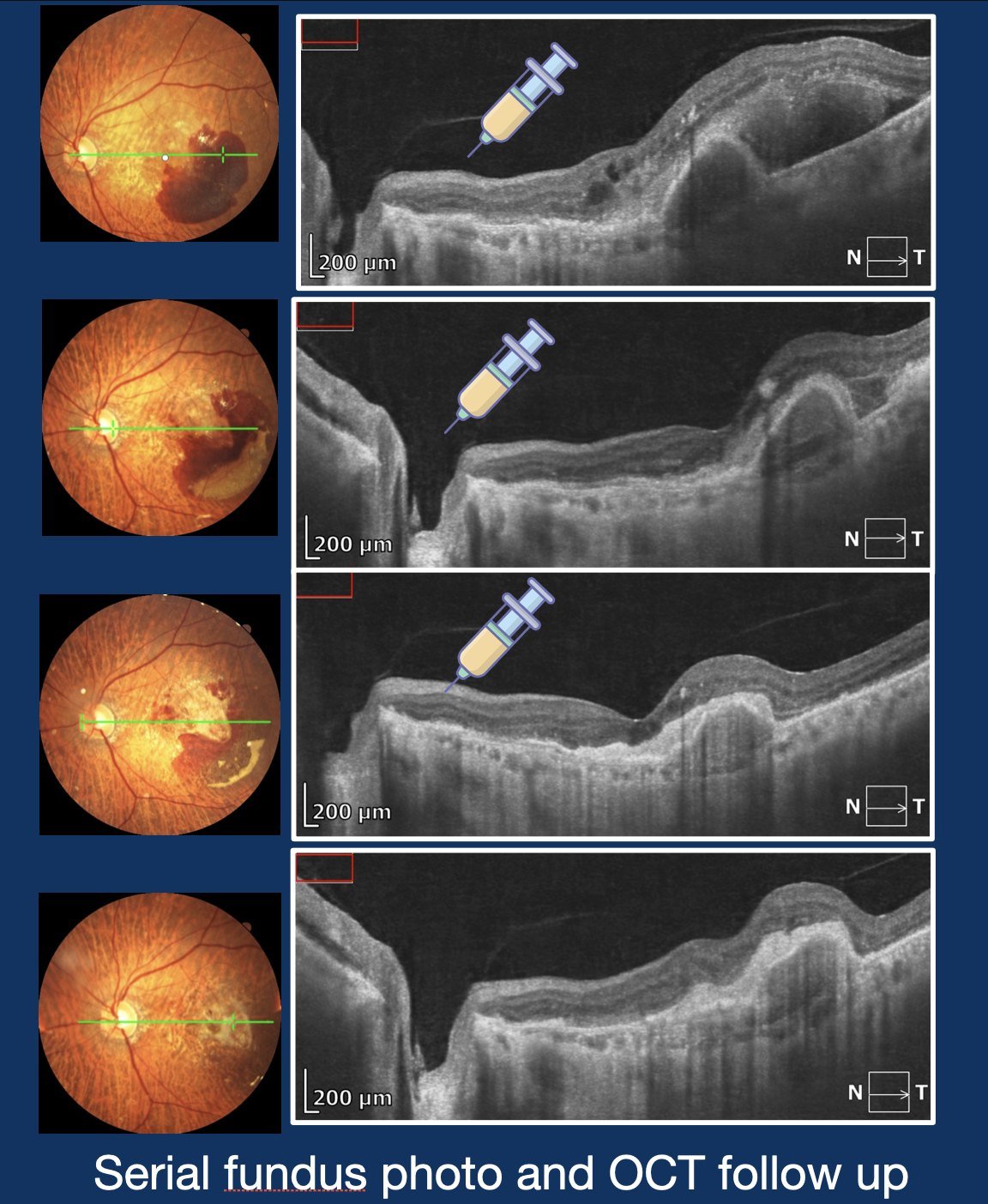 Serial follow-up on sustained anti-VEGF therapy