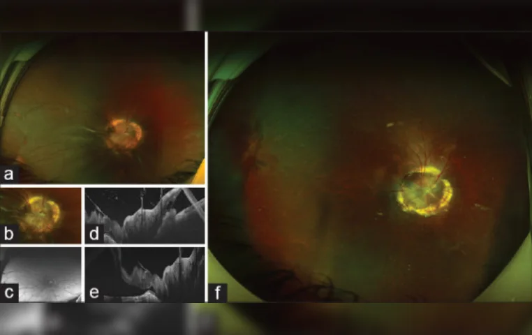 Vitreoretinal surgery in morning glory disc anomaly — Indian Journal of Ophthalmology